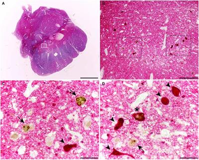 Midbrain catecholaminergic neurons co-express α-synuclein and tau in progressive supranuclear palsy